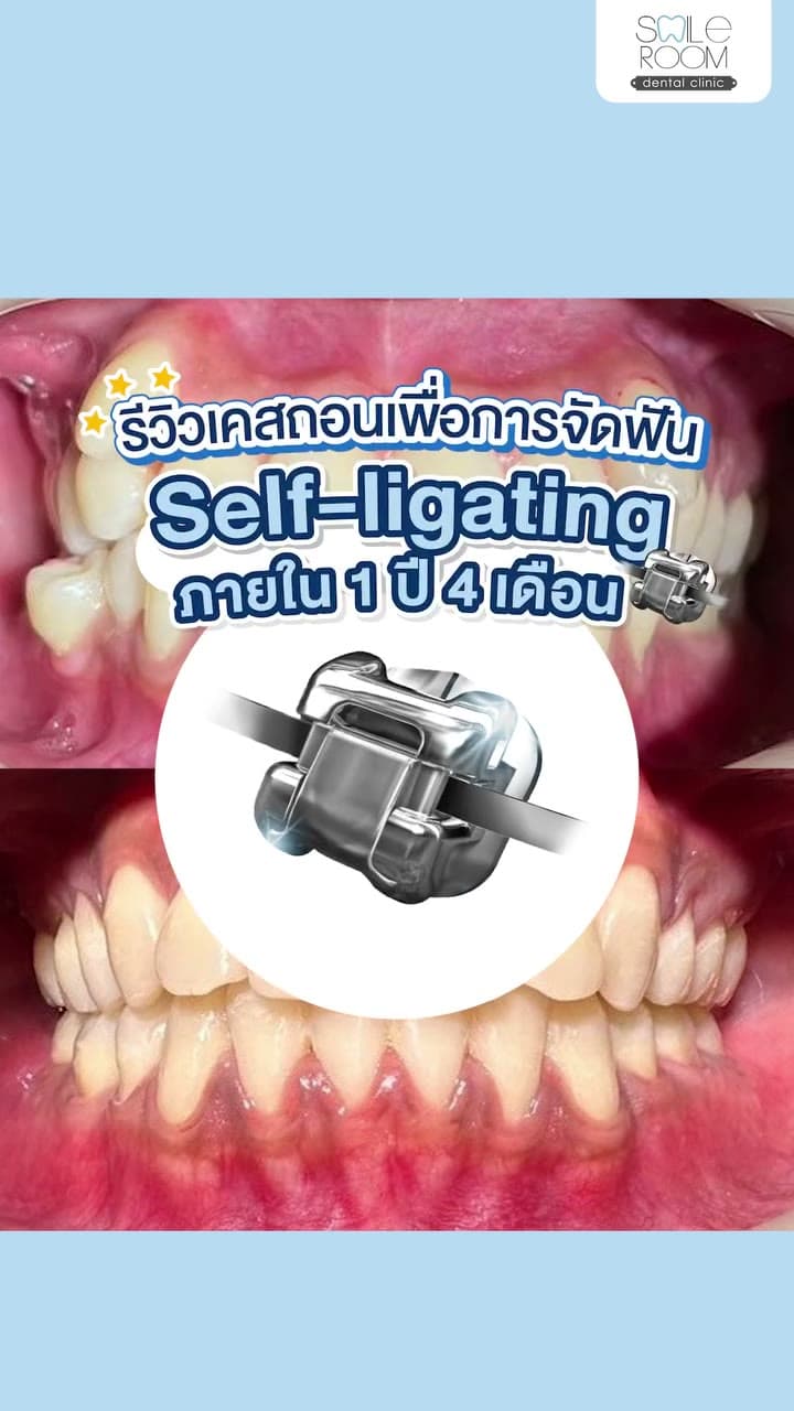 วิดีโอรีวิวเคสจัดฟัน Self-ligating ภาพก่อนและหลังการรักษา ที่ Smile Room